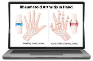 Understanding Wrist Pain Two Conditions That are Often Misdiagnosed as Carpal Tunnel Syndrome