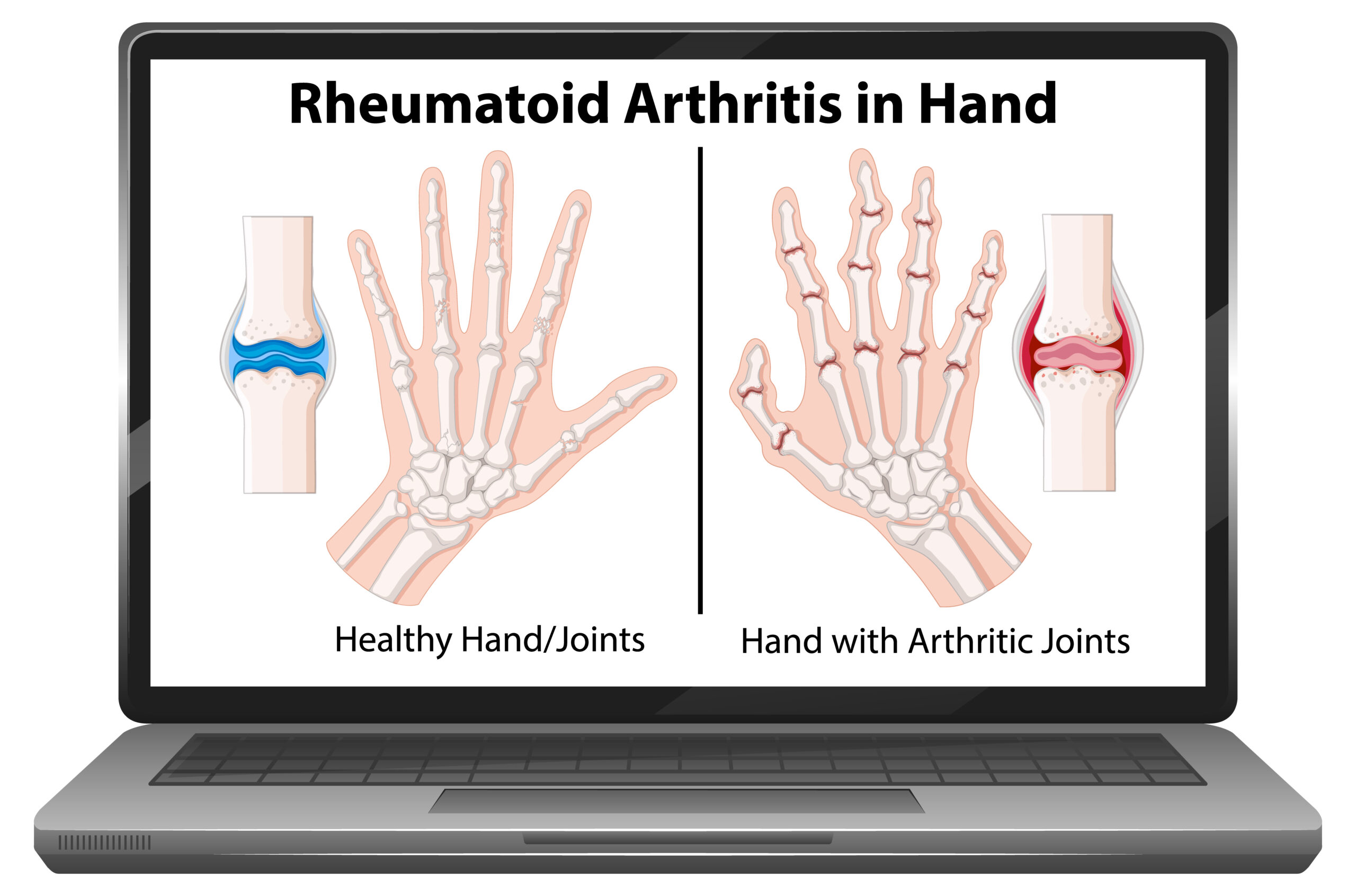 two-conditions-that-are-often-misdiagnosed-as-carpal-tunnel-syndrome